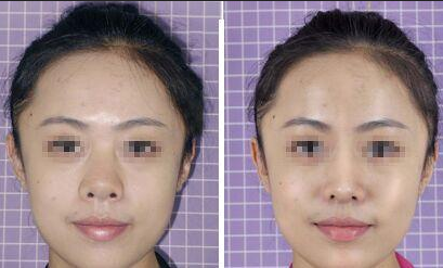 膨體隆鼻后遺癥的出現(xiàn)有哪些？危害大嗎？