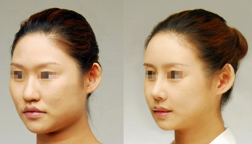 膨體隆鼻可以*嗎？有哪些注意事項(xiàng)？