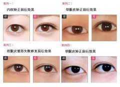 廣州雙眼皮手術(shù)多少錢