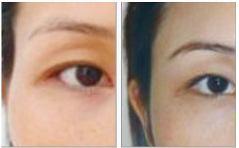 豐太陽穴手術(shù)的價(jià)格一般是多少