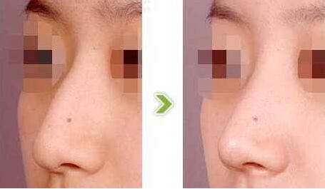 駝峰鼻有哪些類型？駝峰鼻矯正方法全解