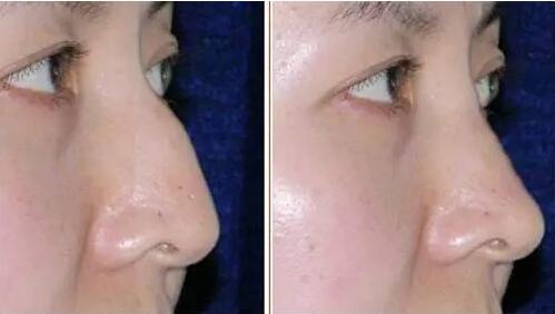 駝峰鼻有哪些類型？駝峰鼻矯正方法全解