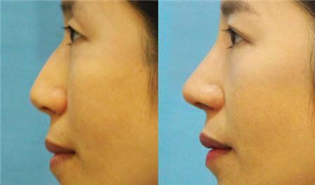 駝峰鼻整形術(shù)后注意事項有哪些？