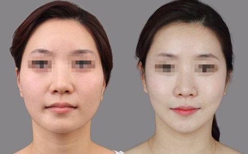 南寧華美整形做顴骨整形手術(shù)怎么樣
