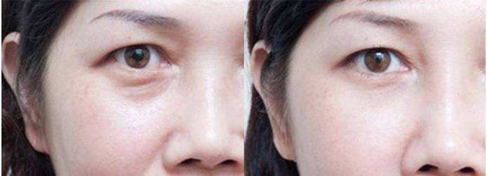 深圳內(nèi)切祛眼袋手術(shù)價(jià)格