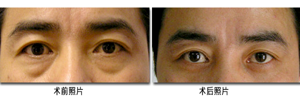 北京內(nèi)切祛眼袋多少錢(qián)