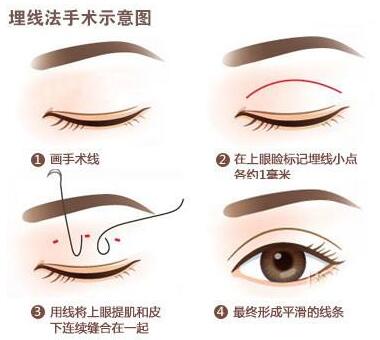 上海埋線雙眼皮價格多少