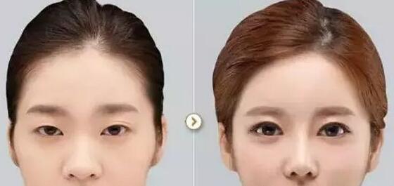 北京埋線雙眼皮貴嗎