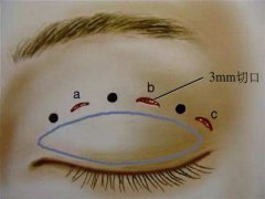深圳韓式三點(diǎn)雙眼皮多少錢