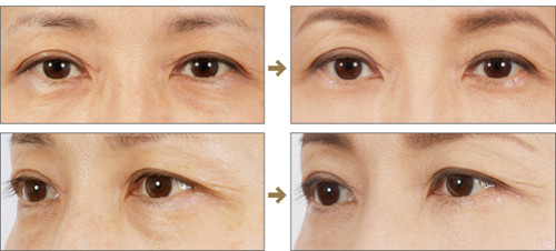 上海激光祛眼袋價(jià)格是多少