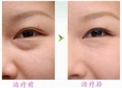 廣東手術(shù)祛眼袋價(jià)格