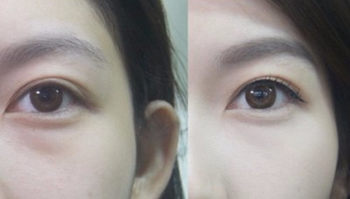 廣東超聲波祛眼袋價格