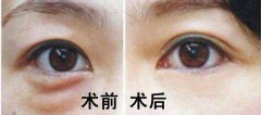 深圳祛眼袋多少錢