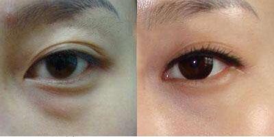 上海超聲波做眼袋多少錢