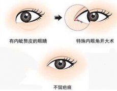 深圳開眼角多少錢