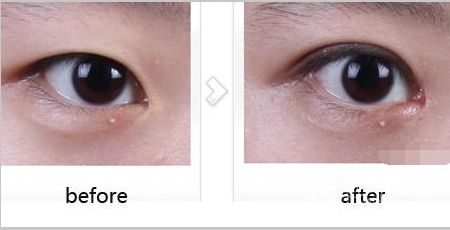 廣東,開外眼角,價格