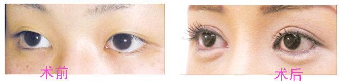 深圳,開外眼角,多少錢