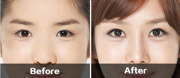 深圳開內(nèi)眼角價格是多少