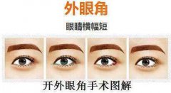 深圳開內(nèi)眼角價(jià)格是多少