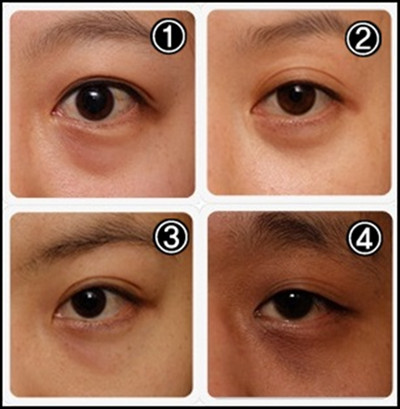 北京激光去黑眼圈多少錢