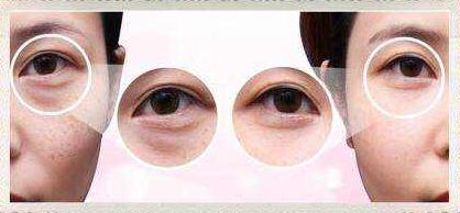 上海激光去黑眼圈價(jià)格