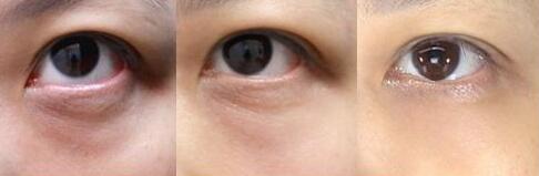 上海激光去黑眼圈價(jià)格