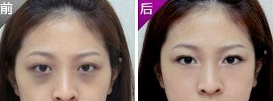 深圳激光去黑眼圈需要多少錢