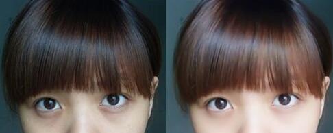 深圳激光去黑眼圈需要多少錢