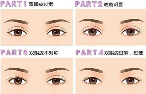 深圳眼部整形失敗修復(fù)需要多少錢