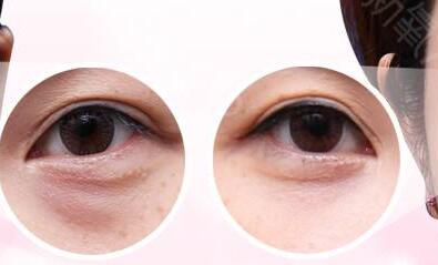 北京,玻尿酸,去黑眼圈,價格