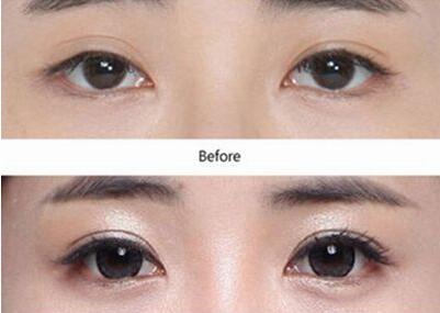 廣東眼部整形失敗修復(fù)手術(shù)費用