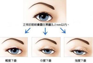 深圳下眼下至術(shù)需要多少錢(qián)