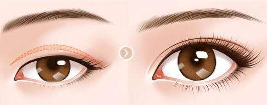 深圳下眼下至術(shù)需要多少錢(qián)