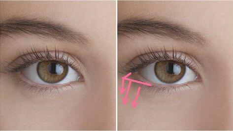 上海下眼下至術價格