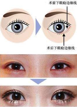 上海下眼下至術(shù)價(jià)格