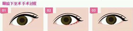 北京下眼下至術(shù)多少錢