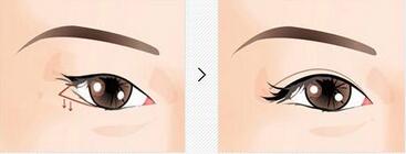 北京下眼下至術(shù)多少錢