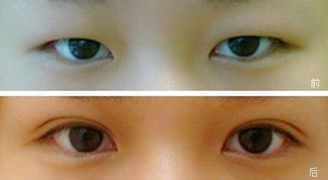深圳眼皮抽脂手術多少錢