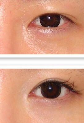 廣東上眼皮去脂價格