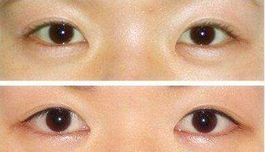 深圳,眼瞼整形,多少錢