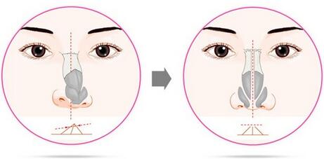 歪鼻矯正費(fèi)用需要多少錢(qián)？