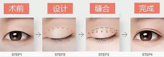 焊接雙眼皮是什么？有哪些特點(diǎn)？