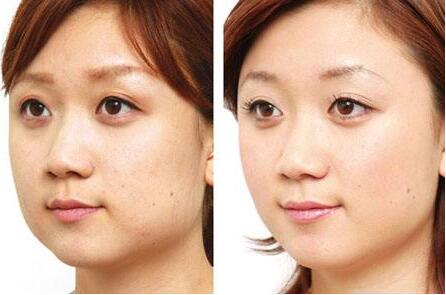 去頰脂墊價(jià)格是多少？貴不貴？