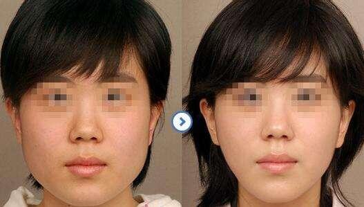 去頰脂墊價格是多少？貴不貴？