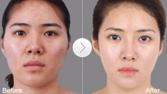 朝天鼻整容多少錢(qián)？