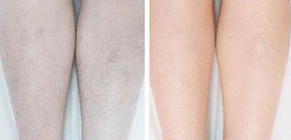 怎樣去除腿毛、*果怎么樣