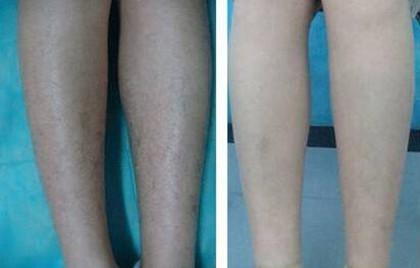 怎樣去除腿毛、*果怎么樣