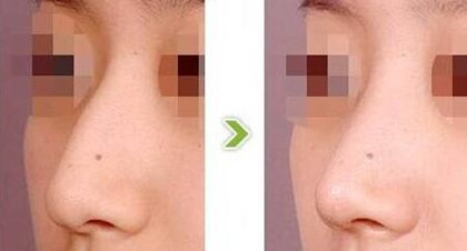 鷹鉤鼻整形要多少錢(qián)