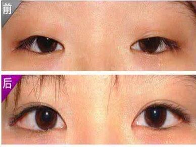 開眼角,費(fèi)用