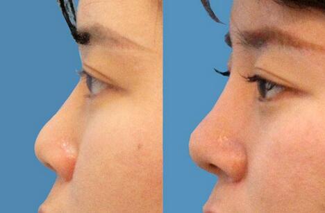 朝天鼻如何矯正 朝天鼻矯正術(shù)前術(shù)后注意事項(xiàng)